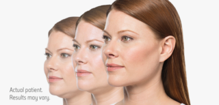 A before and after result for Kybella to eliminate submental, or under the chin, fat. Source: Allergan.