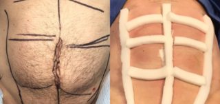An abdominal etching patient of Dr. Zuckerman's pictured before and immediately after his plastic surgery procedure. Patient is wearing post-op compression foam in the after image.