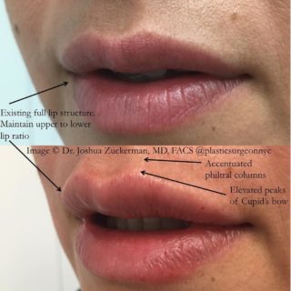  A before and after result of a lip augmentation patient of Dr. Zuckerman's.