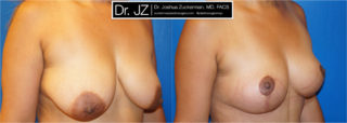 A recent before and after breast lift surgery (mastopexy) result by Dr. Zuckerman. His breast lift will raise the breast mound and leave you with a high, round natural-looking breast.