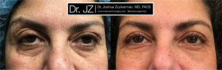 A recent before and after image of a blepharoplasty, eyelid surgery, by Dr. Zuckerman. Patient underwent an upper blepharoplasty with fat grafting to the lower eyelids.
