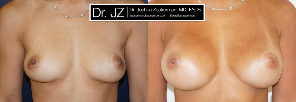 A recent before and after image of a breast augmentation by Dr. Zuckerman. Patient had Mentor round silicone implants placed submuscular.