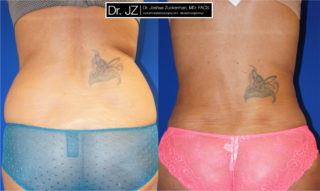 A recent liposuction before and after outcome by Dr. Zuckerman. Patient underwent liposuction of the abdomen, flanks and lower back with fat grafting to the buttocks (buttock augmentation).