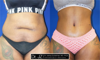 A recent tummy tuck surgery result by Dr. Zuckerman. Patient underwent a combination tummy tuck, liposuction and fat grafting to the buttocks (buttock augmentation).