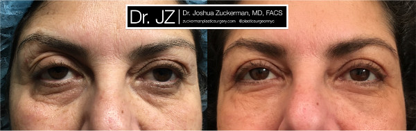 Frontal view of an eyelid surgery outcome by Dr. Zuckerman. Patient underwent an upper blepharoplasty and fat grafting to the lower eyelids. Images were taken before surgery and one month after surgery.