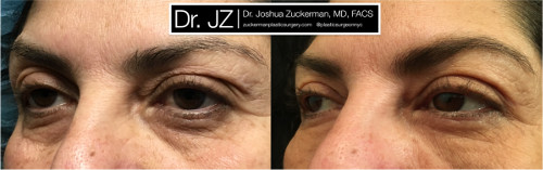 Left oblique view of an eyelid surgery outcome by Dr. Zuckerman. Patient underwent an upper blepharoplasty and fat grafting to the lower eyelids. Images were taken before surgery and one month after surgery.