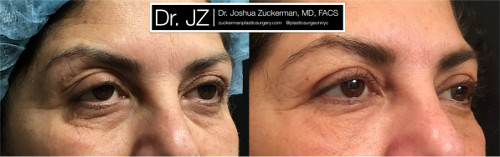 Right oblique view of an eyelid surgery outcome by Dr. Zuckerman. Patient underwent an upper blepharoplasty and fat grafting to the lower eyelids. Images were taken before surgery and one month after surgery.