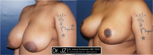 Left oblique view of a breast reduction surgery outcome from Dr. Zuckerman before surgery and one year after surgery.