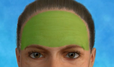 Illustrative brow lift image demonstrating the addressable areas of this cosmetic surgery procedure.