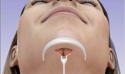 An illustration of the incision made below the chin to place a chin implant for chin augmentation.