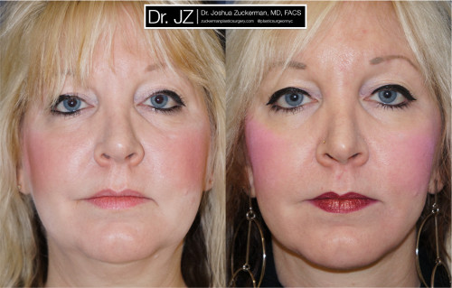 facelift, before and after, 1, frontal