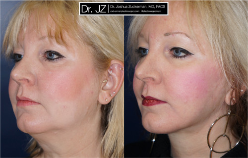 facelift, before and after, 1, left oblique