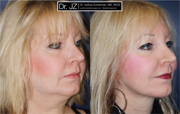 facelift, right oblique, 1, before and after, joshua zuckerman, plastic surgeon