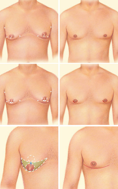 An illustration of the three possible ways that Dr. Zuckerman may perform male breast reduction surgery in increasing severity. Top: Liposuction only, Middle: Liposuction plus areolar incision, Bottom: modified Roberts pattern. Source: ASPS