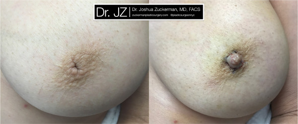 One of Dr. Zuckerman's inverted nipple surgery outcomes. Images were taken before the procedure and immediately post-op.
