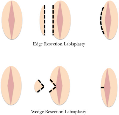 A comparison of the edge resection labiaplasty technique versus the wedge resection labiaplasty.
