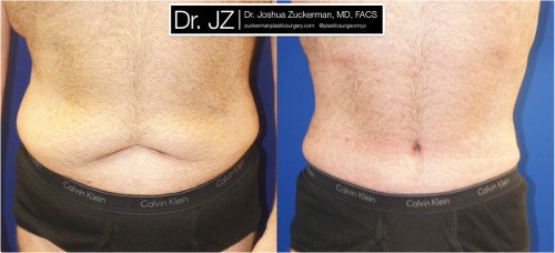 Frontal view of a post weight loss surgery patient. Dr. Zuckerman performed a tummy tuck after this patient had previously lost 100lbs. Images taken before surgery and three months post-op.