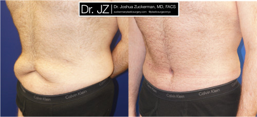 Left oblique view of a post weight loss surgery patient. Dr. Zuckerman performed a tummy tuck after this patient had previously lost 100lbs. Images taken before surgery and three months post-op.