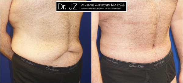Right oblique view of a post weight loss surgery patient. Dr. Zuckerman performed a tummy tuck after this patient had previously lost 100lbs. Images taken before surgery and three months post-op.