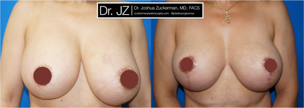 Frontal view of a before and after of breast augmentation / mastopexy revision surgery Dr. Zuckerman performed. Patient was unhappy with asymmetry from a previous cosmetic surgery procedure, which had also damaged her left nipple. Dr. Zuckerman performed an implant exchange and breast lift. Images taken before surgery and one month after surgery.