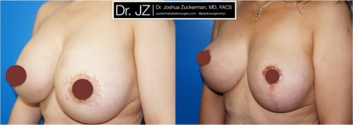 Left oblique view of a before and after of breast augmentation / mastopexy revision surgery Dr. Zuckerman performed. Patient was unhappy with asymmetry from a previous cosmetic surgery procedure, which had also damaged her left nipple. Dr. Zuckerman performed an implant exchange and breast lift. Images taken before surgery and one month after surgery.