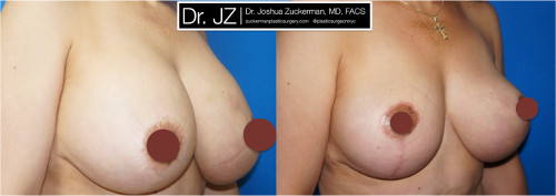 Right oblique view of a before and after of breast augmentation / mastopexy revision surgery Dr. Zuckerman performed. Patient was unhappy with asymmetry from a previous cosmetic surgery procedure, which had also damaged her left nipple. Dr. Zuckerman performed an implant exchange and breast lift. Images taken before surgery and one month after surgery.