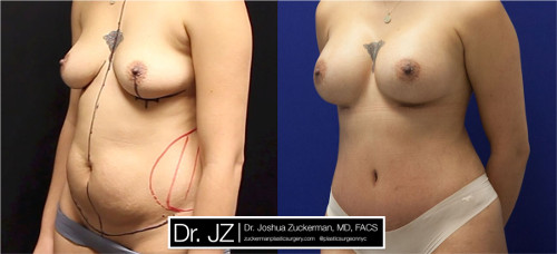 mommy makeover, 1, before and after, left oblique view, joshua zuckerman, plastic surgery