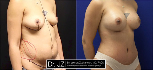 mommy makeover, before and after, 1, right oblique, view, joshua zuckerman, plastic surgery