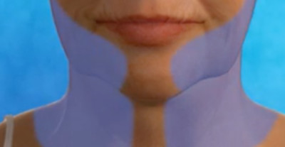 An illustration of the areas that neck lift surgery by Dr. Zuckerman will address.