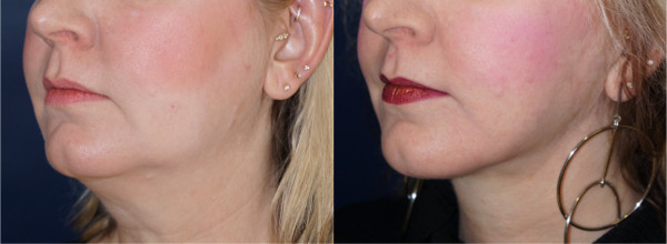 Left oblique view of a neck lift patient by Dr. Zuckerman. Images were taken before surgery and one year post-op.