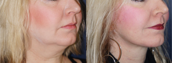 Right oblique view of a neck lift patient by Dr. Zuckerman. Images were taken before surgery and one year post-op.