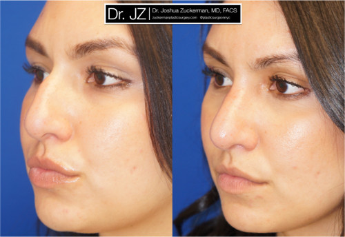 Left oblique view of rhinoplasty patient of Dr. Zuckerman. Images were taken before surgery and three months after surgery.