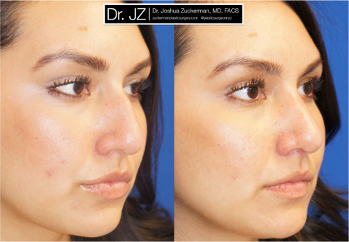 Right oblique view of rhinoplasty patient of Dr. Zuckerman. Images were taken before surgery and three months after surgery.