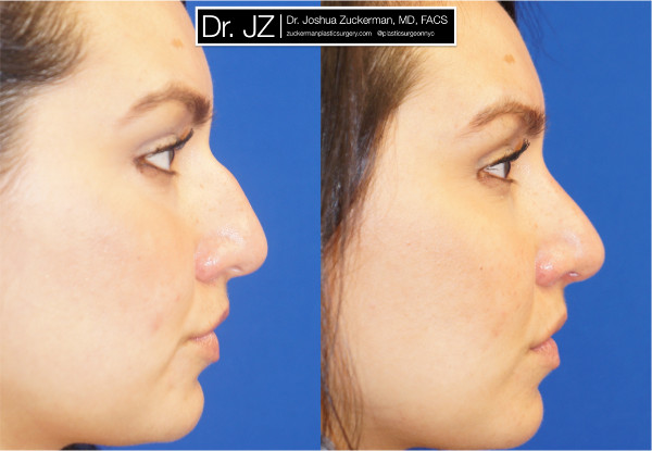 Right profile view of rhinoplasty patient of Dr. Zuckerman. Images taken before surgery and three months after surgery.