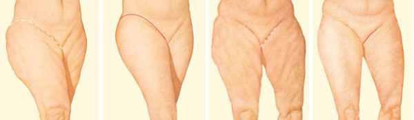 Example incision patterns for thigh lift surgery. Source: American Society of Plastic Surgeons