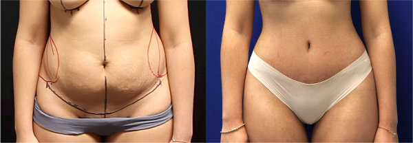 One of Dr. Zuckerman's tummy tuck surgery outcomes from a patient in New York City. Images were taken before surgery and three months after surgery.