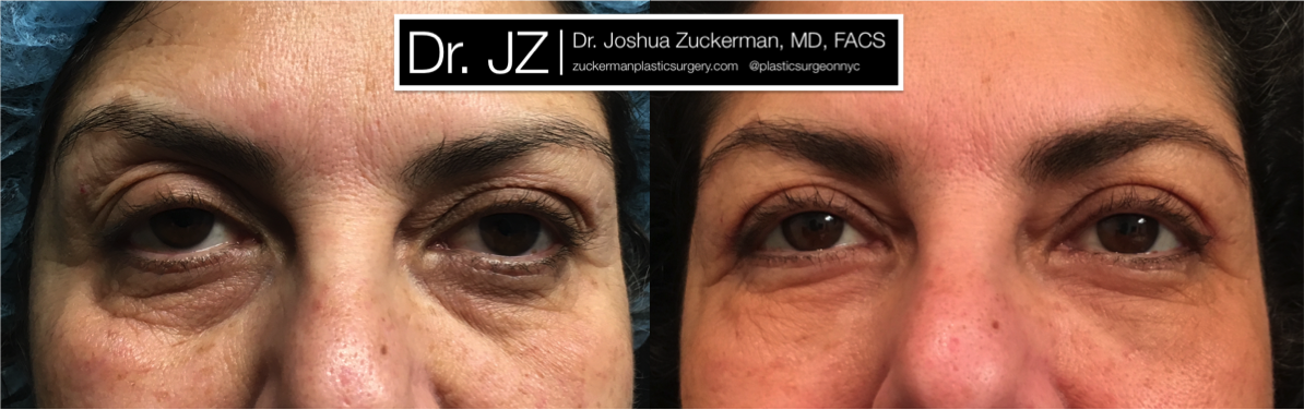 Frontal view of Blepharoplasty patient, female, 1 month post-op. Also performed fat grafting to the lower eyelids and tear troughs.