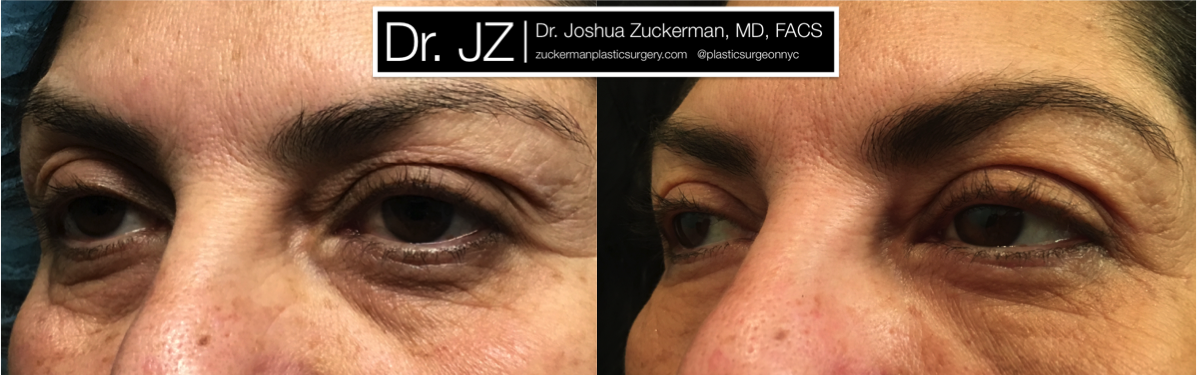 Left oblique view of Blepharoplasty patient, female, 1 month post-op. Also performed fat grafting to the lower eyelids and tear troughs.