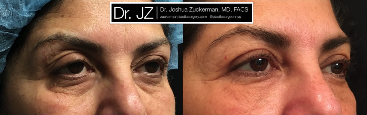 Right oblique view of Blepharoplasty patient, female, 1 month post-op. Also performed fat grafting to the lower eyelids and tear troughs.