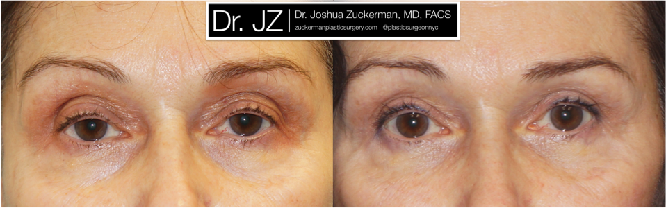 Frontal view of Blepharoplasty patient, female, 3 months post-op. Upper blepharoplasty with fat grafting to the lower eyelids and tear troughs.