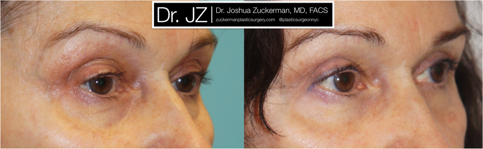 Right oblique view of Blepharoplasty patient, female, 3 months post-op. Upper blepharoplasty with fat grafting to the lower eyelids and tear troughs.