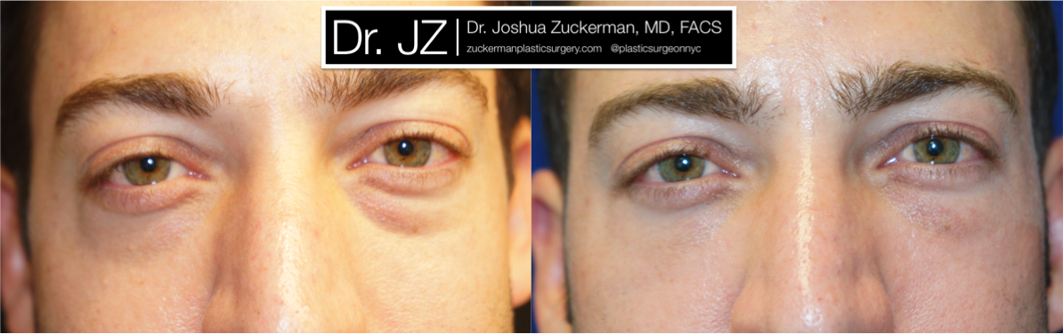Frontal view of Blepharoplasty patient, male, 1.5 months post-op. Lower eyelid blepharoplasty with fat grafting to tear troughs. Result will continue to improve until final result around 3 months.