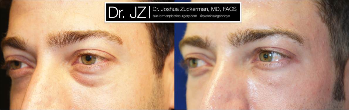 Left oblique view of Blepharoplasty patient, male, 1.5 months post-op. Lower eyelid blepharoplasty with fat grafting to tear troughs. Result will continue to improve until final result around 3 months.