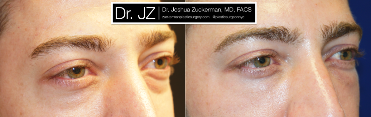 Right oblique view of Blepharoplasty patient, male, 1.5 months post-op. Lower eyelid blepharoplasty with fat grafting to tear troughs. Result will continue to improve until final result around 3 months.
