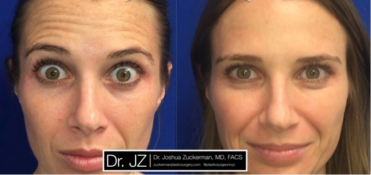 Frontal view of Botox treatment for transverse (horizontal) lines on the forehead. Images taken before treatment and seven days after.