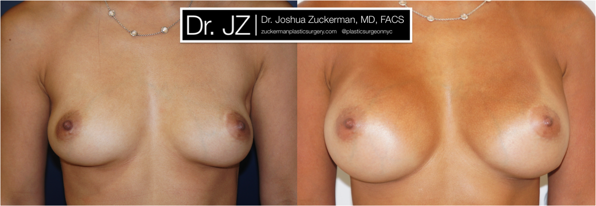 Frontal view of Breast Augmentation patient, female, 1 year post-op. 255cc Sientra round silicone breast implants. Submuscular implacement, Inframammary fold incision.