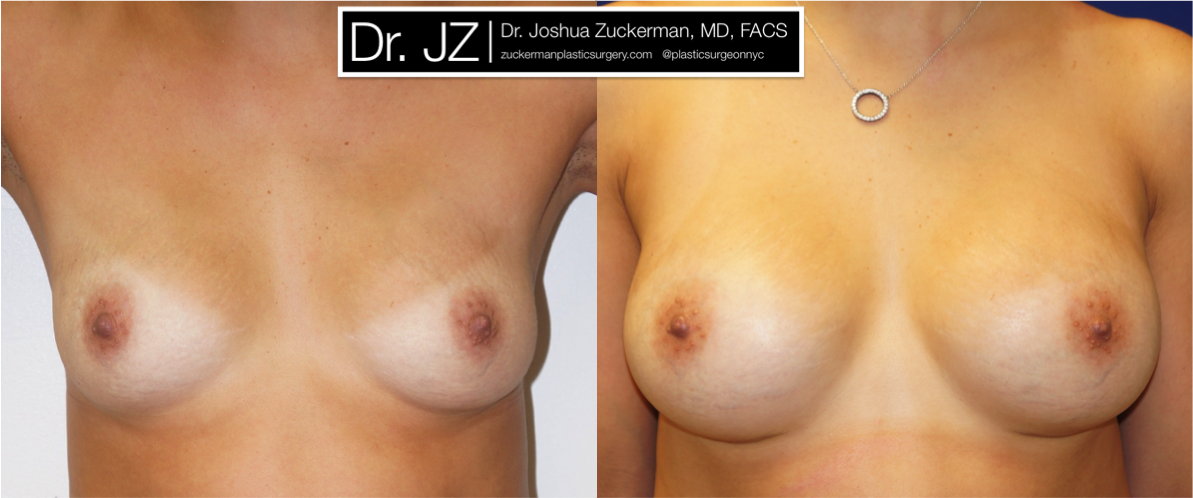 Frontal view of Breast Augmentation patient, female, 1 year post-op. 325cc on the right, 350cc on the left to correct existing breast asymmetry. Mentor Smooth Round Moderate-Plus Profile breast implants.