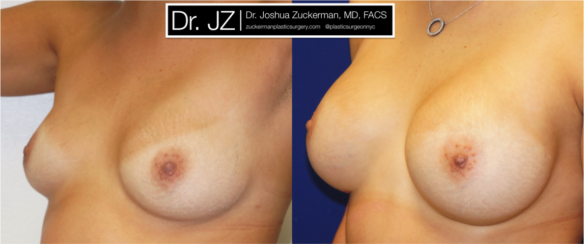 Left oblique view of Breast Augmentation patient, female, 1 year post-op. 325cc on the right, 350cc on the left to correct existing breast asymmetry. Mentor Smooth Round Moderate-Plus Profile breast implants.