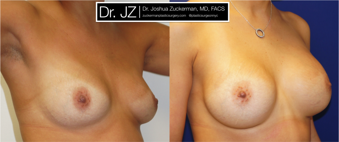 Right oblique view of Breast Augmentation patient, female, 1 year post-op. 325cc on the right, 350cc on the left to correct existing breast asymmetry. Mentor Smooth Round Moderate-Plus Profile breast implants.