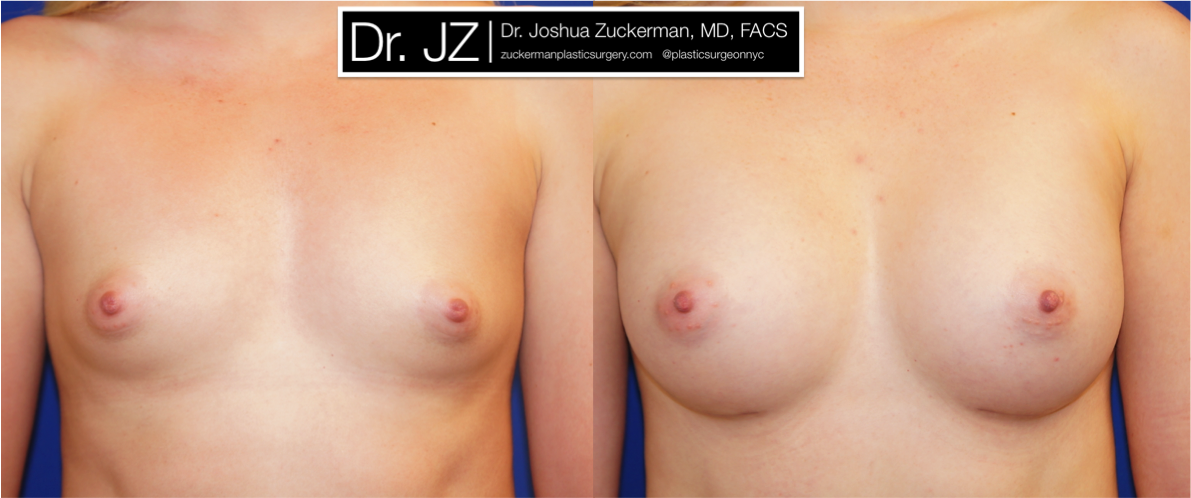 Frontal view of Breast Augmentation patient, female, 2 months post-op. 275cc Mentor Smooth Round High Profile breast implants.